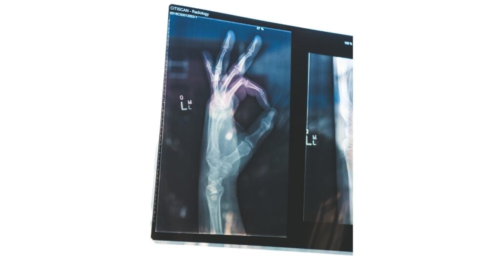 an xray photo shows hand doing okay or alright hand gesture
